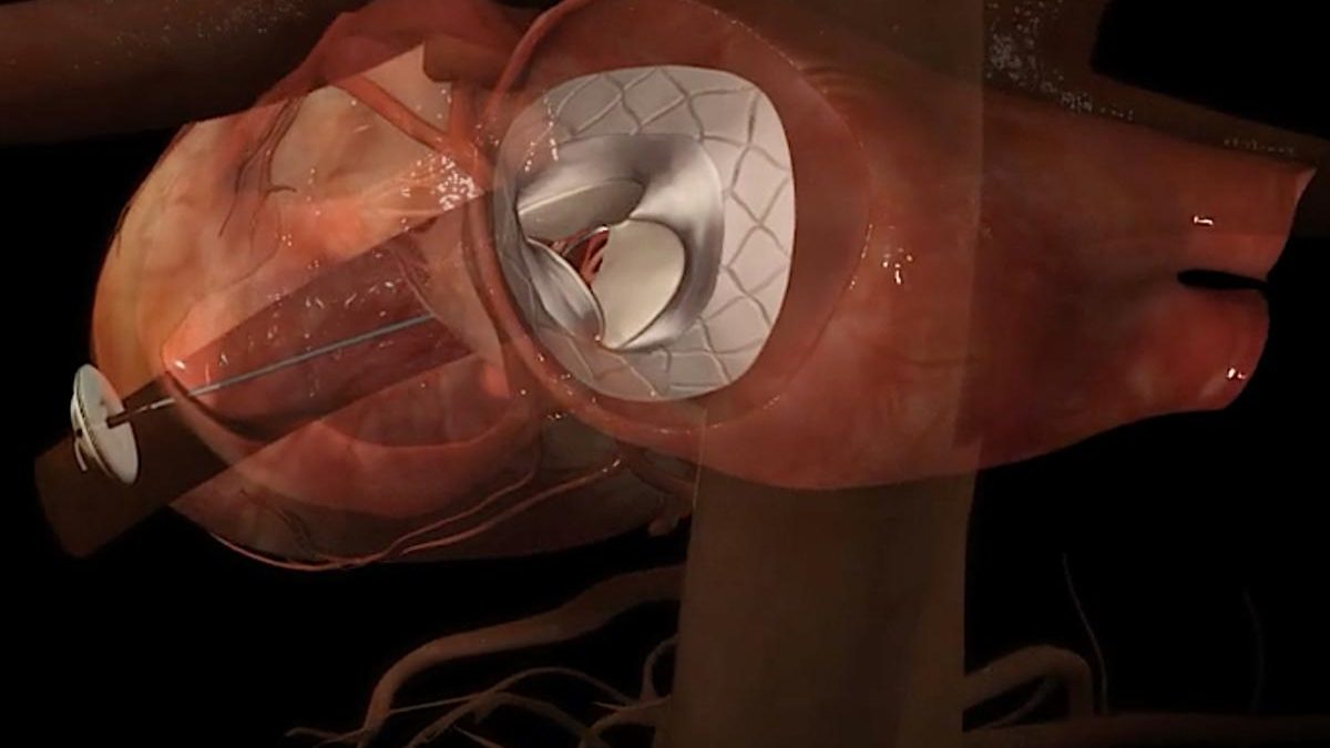 World's First Transcatheter Mitral Valve