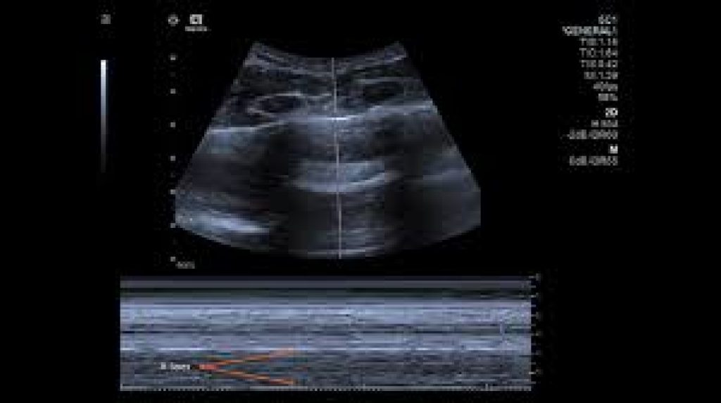 IIT-Palakkad develops ultrasound for COVID-19 screening