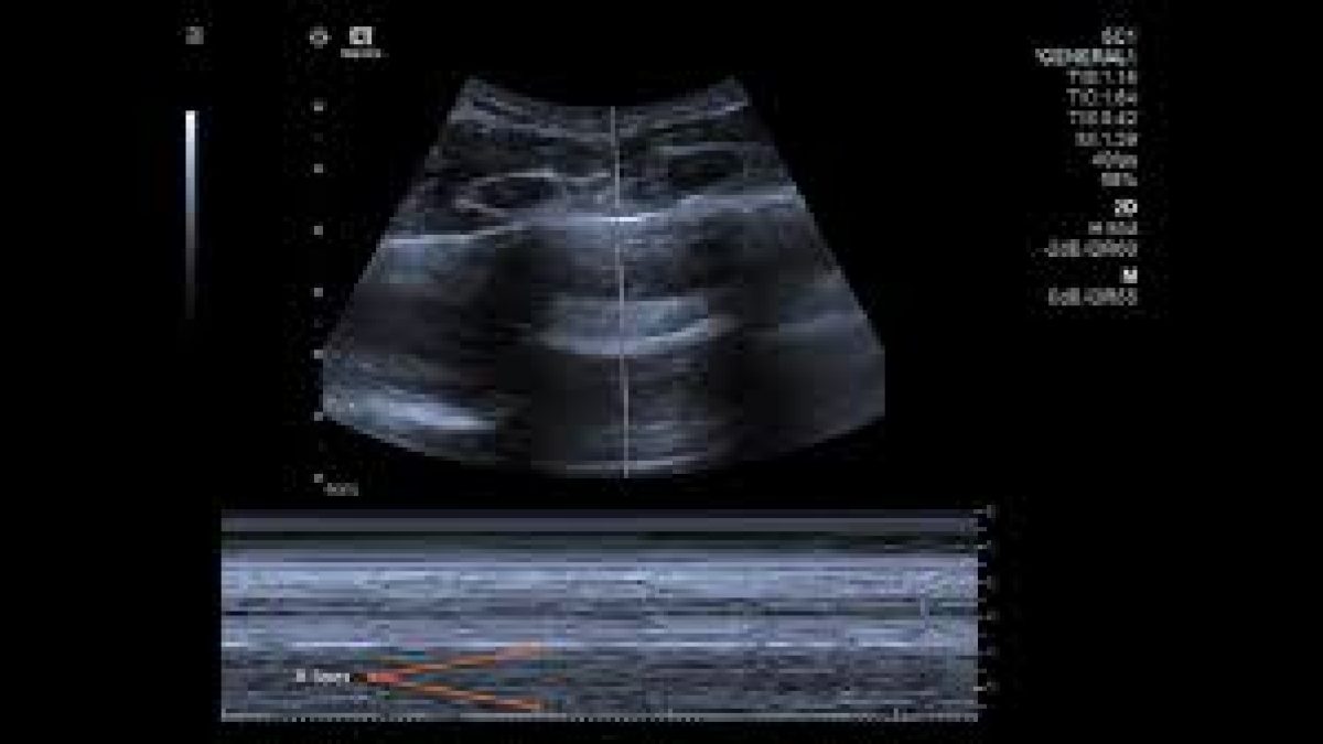 IIT-Palakkad develops ultrasound for COVID-19 screening