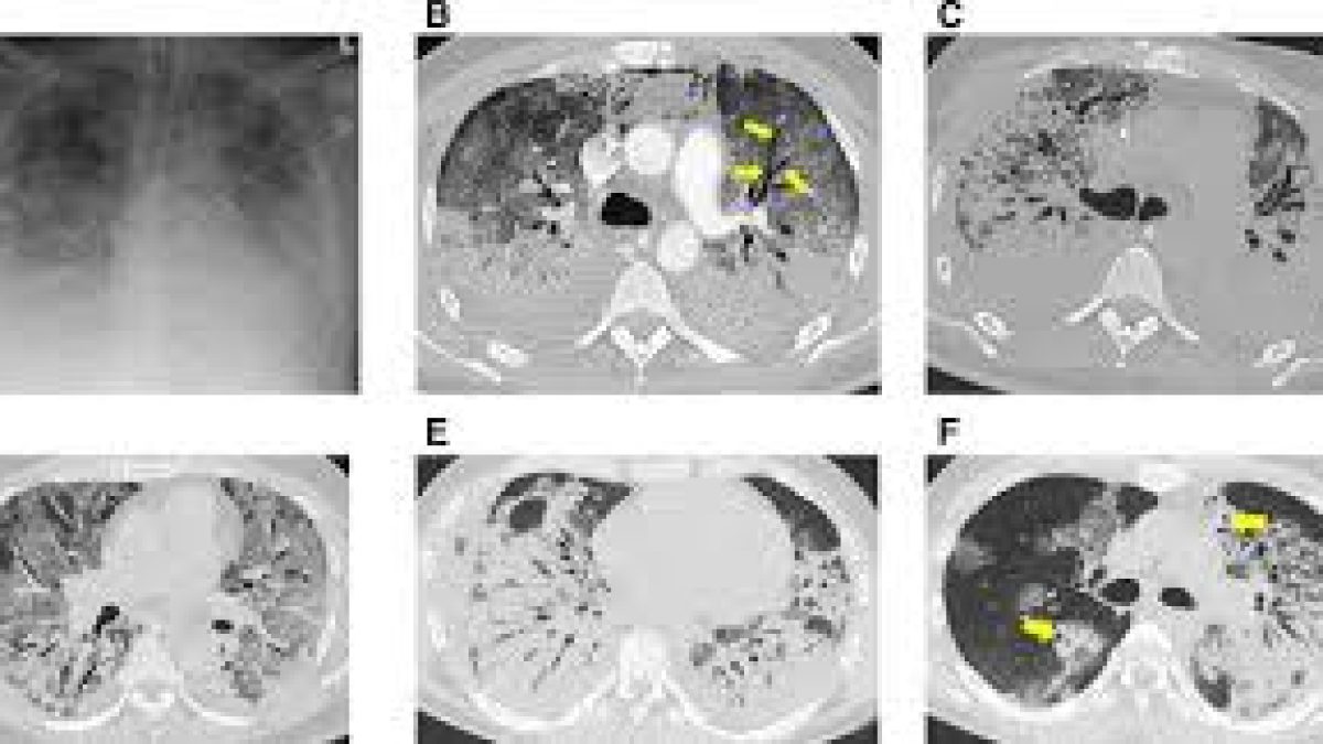 Covid 19 symptoms and CT scan