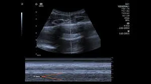 IIT-Palakkad develops ultrasound for COVID-19 screening