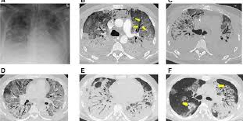 Covid 19 symptoms and CT scan