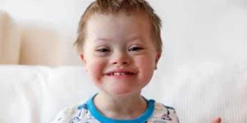 Down Syndrome: Types, Physical Features