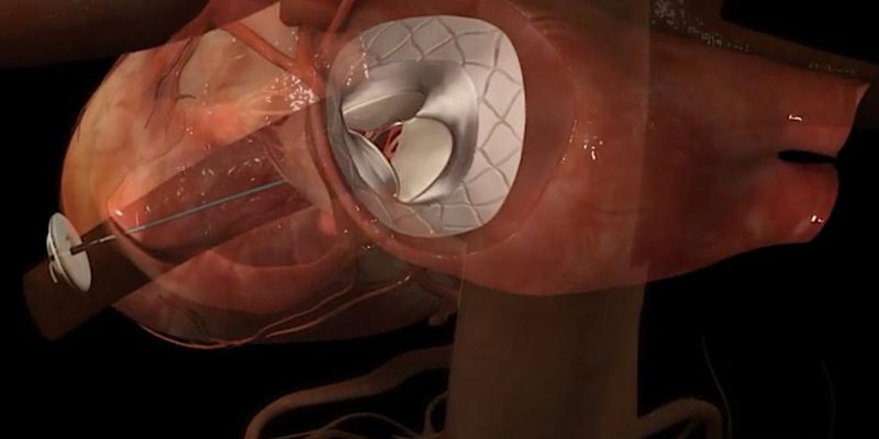 World’s First Transcatheter Mitral Valve