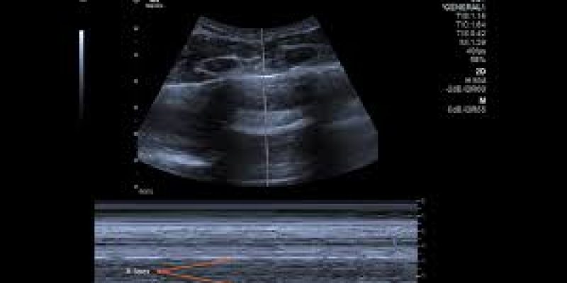 IIT-Palakkad develops ultrasound for COVID-19 screening